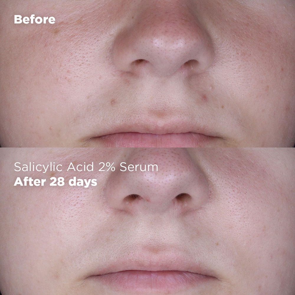 Reveal Radiant Skin Benefits of Salicylic Acid Serum Reveal Radiant Skin Benefits of Salicylic Acid Serum
